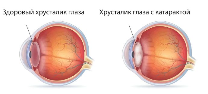 Здоровый хрусталик и хрусталик с катарактой